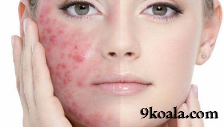 3 GÜN İÇİNDE SİVİLCELERDEN KURTULMANIN 4 YOLU